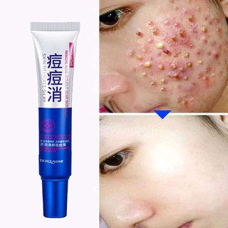 #86 Acne cream ครีมรักษาสิว ครีมแต้มสิว เจลรักษาสิว ครีมลบสิว ครีมรักษารอยสิวรอยแดง เครื่องสำอางสำหรับผู้ที่เป็นสิว