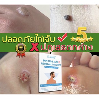 Skin tag &amp; Acne removal แผ่นแปะ ขี้แมงวัน หูด กะเนื้อ