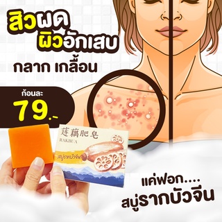 📌[ของแท้ ส่งฟรี] 🧼 สบู่รากบัว รักษากลากเกลื้อน เชื้อรา โรคผิวหนังต่างๆ