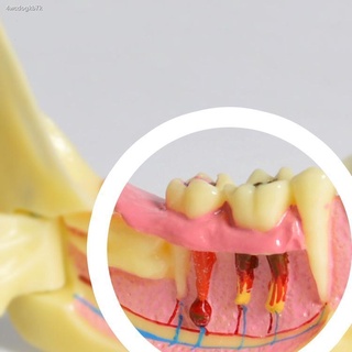 ทันตกรรม┅☑♙แบบจำลองการสลายตัวของเนื้อเยื่อขากรรไกรล่างแบบครึ่งด้านแบบเปิดได้แบบจำลองการสลายตัวของรากฟันผุ
