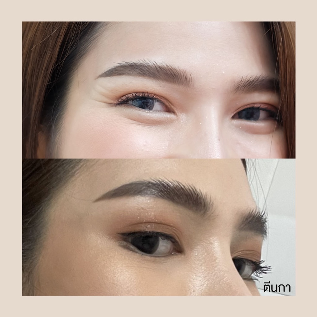 Botox (Aestox) Wrinkles โบท็อก ริ้วรอย ตีนกา หว่างคิ้ว ริ้วรอยหน้าผาก โบปีกจมูก