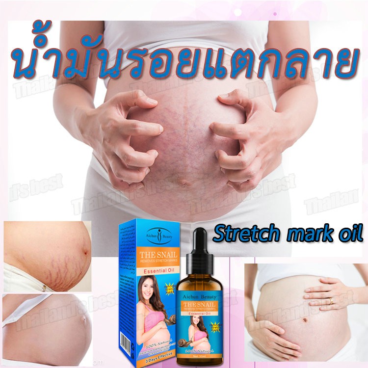 ลบเครื่องหมายยืด กันท้องลาย ครีมทาท้อง พาสเจล ลดผิวแตกลาย ครีมแก้ท้องลาย ครีมบำรุงผิว Stretch mark o