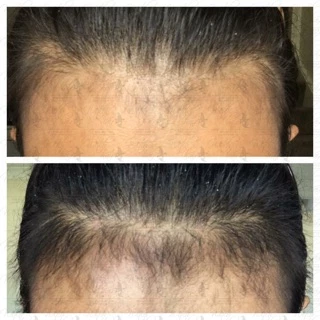 📣Witch Hair เซรั่มปลูกผม คิ้ว หนวด ขวดแรกเห็นผล💯% ขนาด 60ml.