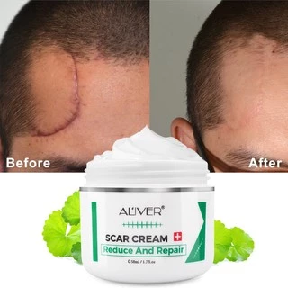 ของแท้ ALIVER ครีมลดรอยแผลเป็น แผลเป็น รแผลไฟไหม้ น้ำร้อนลว แผลผ่าตัด รอยแตกลายหลังครรภ์ แผลเป็นใหม่และแผลเป็นเก่า 50ml