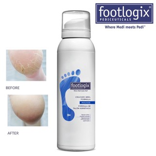 Footlogix Cracked Heel Formula mousse 125ml 3+ blue ฟุตโลจิสต์ ส้นเท้าแตก บำรุงผิวเท้าแห้ง มูสทาเท้า