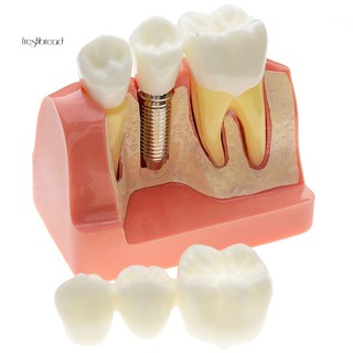 CST_Dental Removable Teeth Implant Restoration Model Study Analysis Demonstration