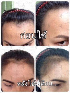 📣Witch Hair เซรั่มปลูกผม คิ้ว หนวด ขวดแรกเห็นผล💯% ขนาด 60ml.