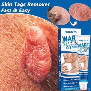 Skin Tag Removal Cream Wart Removing Serum Painless Treatment For Papilloma Flat Wart Genital Beauty Herbal Body Ointmen