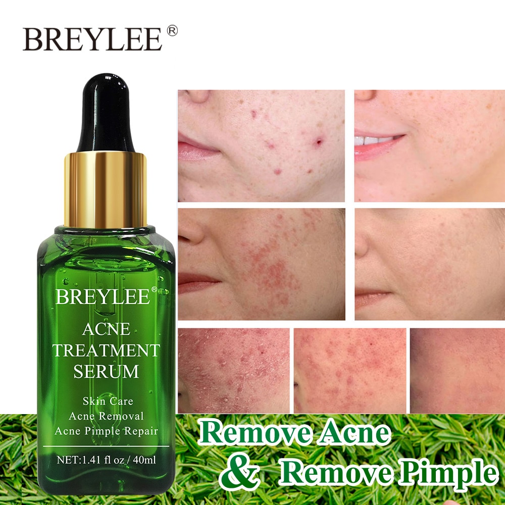 serum facial anti acne
