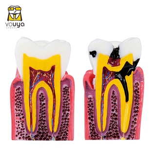 Tooth Model 6 Times Caries Comparison Model Molar Pathology Anatomy Comparative Model Oral Model Teaching Model CBIH