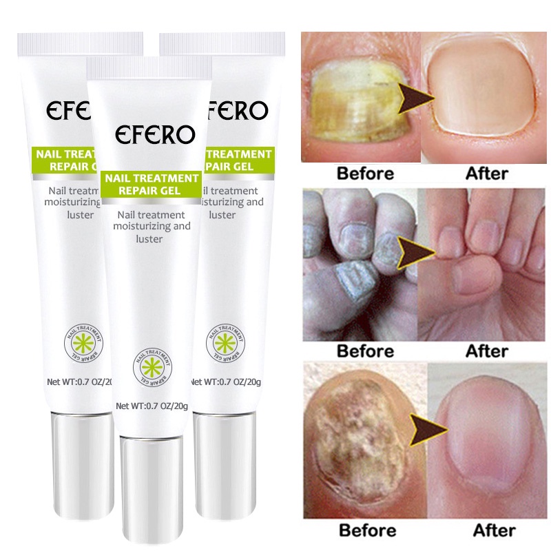 ระวังมือและเท ้ าสําหรับเล ็ บ Efero
