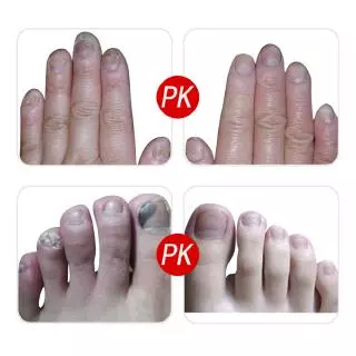 LANBENA Nail Repair Essence 15ml น้ำตบบำรุงเล็บ ซ่อมแซมเล็บเสีย ฟื้นฟูให้ขาวใส บำรุงมือและเล็บเท้า