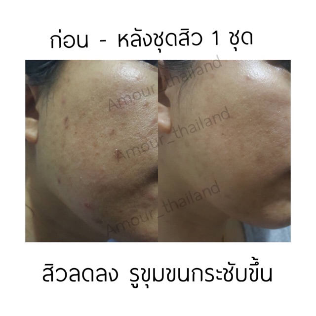 AMOUR Acne Lotion for acne ราคา ถูกที่สุด ดีลบีเคเค แกลเลอรีภาพที่ 8