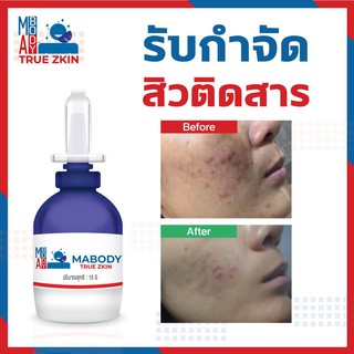 กำจัดหลุมสิว รอยสิว แผลเป็นสิว จุดด่างดำ  Ma Body True Zkin