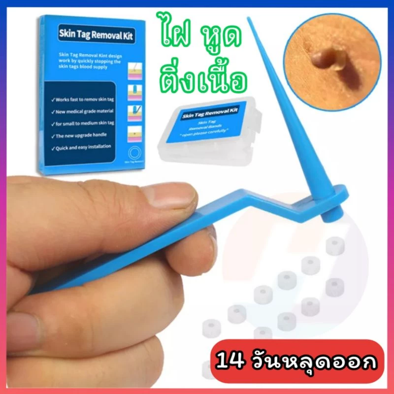 ✓✓จัดส่งในไทย✓✓ อุปกรณ์กำจัดหูด ไฝ ติ่งเนื้อ หลุดออกอย่างง่ายดาย Medical Skin Tag Kill Remover ไม่ต้องใช้ เครื่องจี้ไฝ