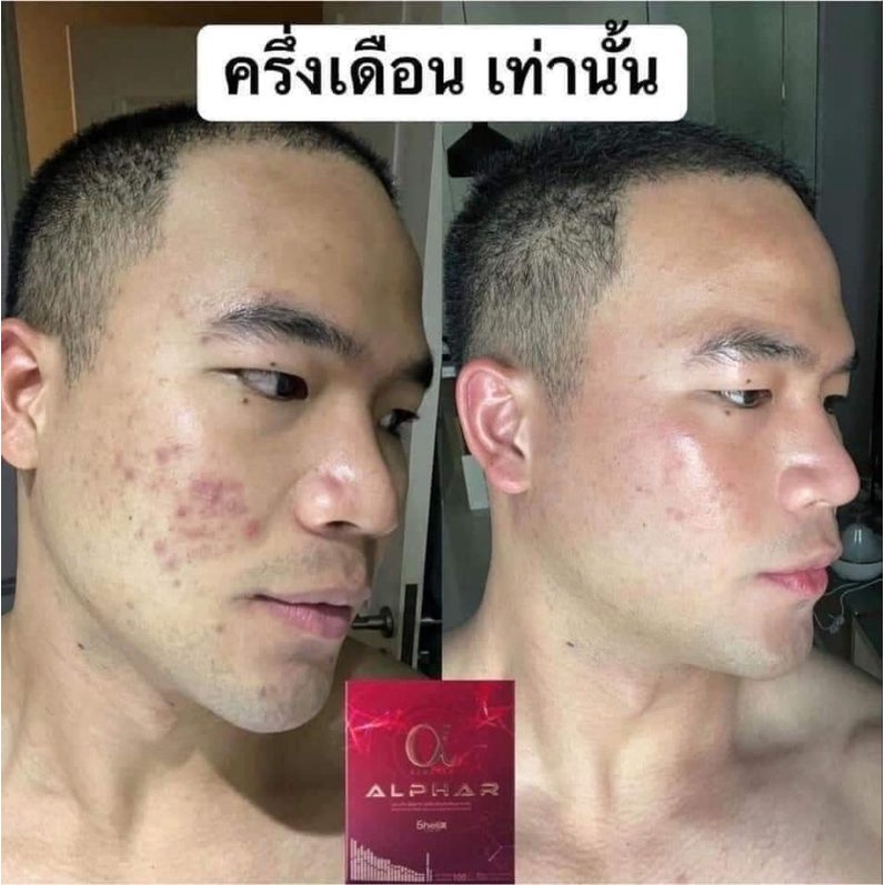 ใหม่ Renatar AlphaR คอลลาเจนบำรุงผิวขาวใส ชะลอวัย กระ ฝ้า จางลง ...