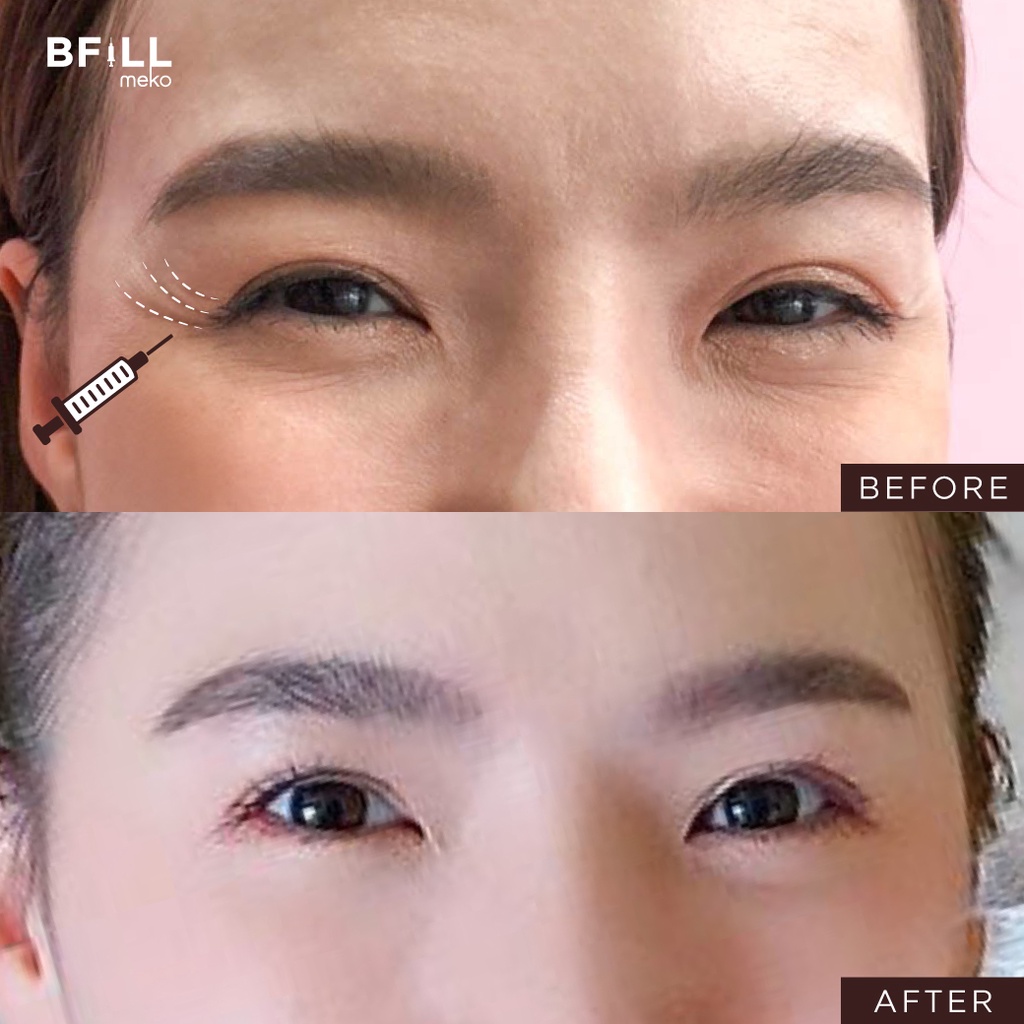 Botox (Aestox) Wrinkles โบท็อก ริ้วรอย ตีนกา หว่างคิ้ว ริ้วรอยหน้าผาก โบปีกจมูก