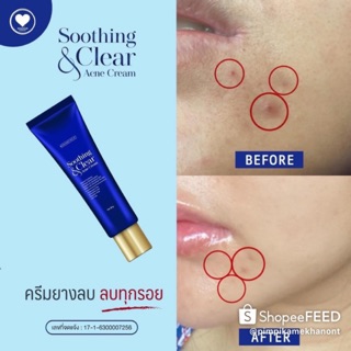 ครีมยางลบแต้มสิว (Eraser Anti Acne)