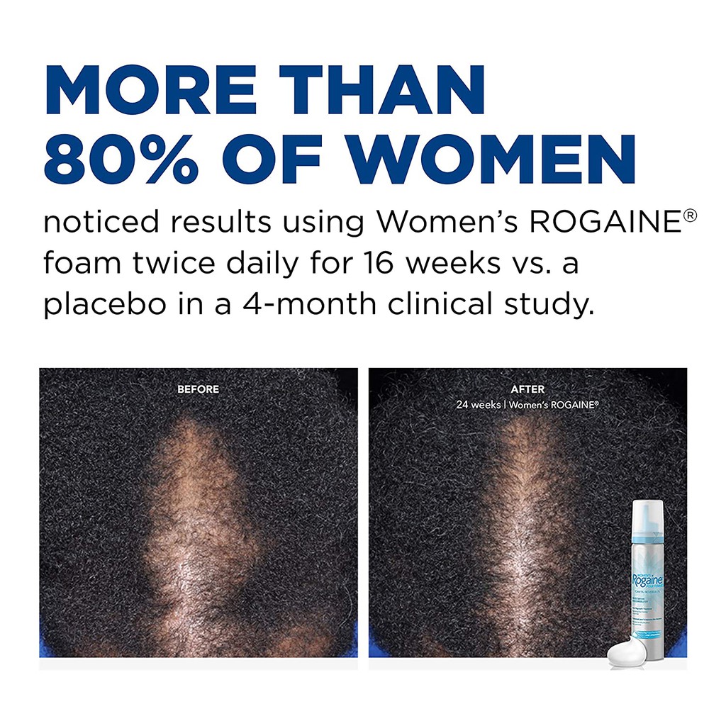 Women's Rogaine Minoxidil Foam 1 ขวด ใช้ได้ 2 เดือน ของแท้ ราคาถูกที่สุด oAqc