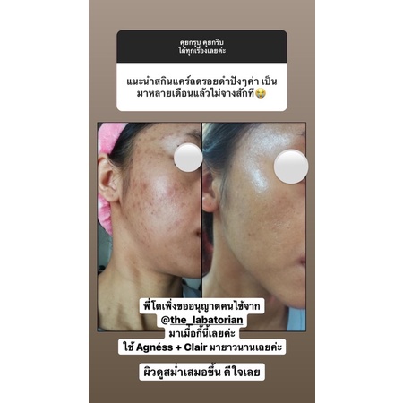✻❦The Labatorian  Agness เซรั่มสำหรับคนเป็นสิว
