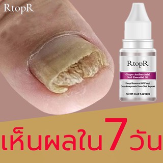 บอกลาปัญหาเล็บต่างๆ Rtporเซรั่มบำรุงเล็บ ปรับปรุงเล็บให้แข็งแรงและมีสุขภาพดีใน2-4 สัปดาห์(ยาหยอดเล็บขบ ยาฆ่าเชื้อราเล็บ）