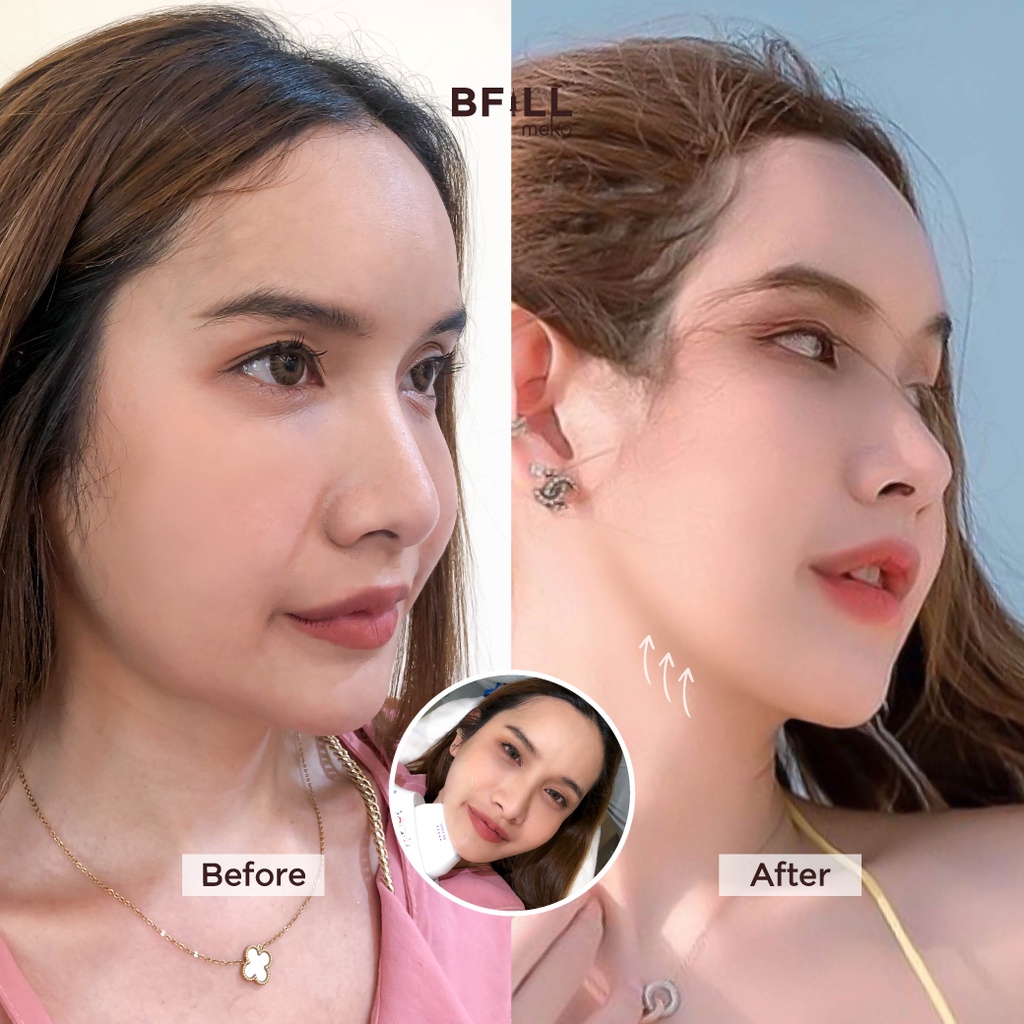 Premium Hifu By Doctor พรีเมียม ไฮฟู่ ทำโดยคุณหมอ