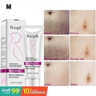 cream for removal of stretch marks