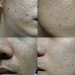 the labatorian acne serum