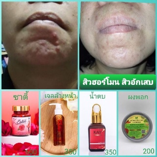 สิวฮอร์โมน สิวมดลูก สิวอักเสบ สิวบริเวณคาง สิวภายในผู้หญิง