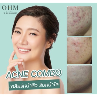 🎉Acne Combo เคลียร์หน้าสิว รับหน้าใส สิวหาย ผิวเนียนได้ โดยแพทย์ผู้เชี่ยวชาญ🎉