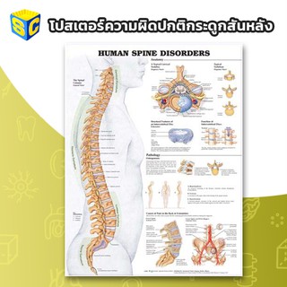 โปสเตอร์วิทยาศาสตร์ ความผิดปกติของกระดูกสันหลัง Human Spine Disorders Anatomical Chart