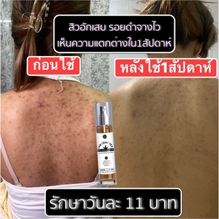 สเปรย์รักษาสิวที่หลัง สิวหน้าอก สิวใบหน้า สูตรแพทย์แผนไทย สเปรย์รักษารอยดำหลัง สเปรย์ใบชา