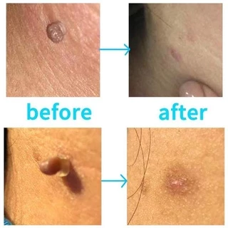 ✓✓จัดส่งในไทย✓✓ อุปกรณ์กำจัดหูด ไฝ ติ่งเนื้อ หลุดออกอย่างง่ายดาย Medical Skin Tag Kill Remover ไม่ต้องใช้ เครื่องจี้ไฝ