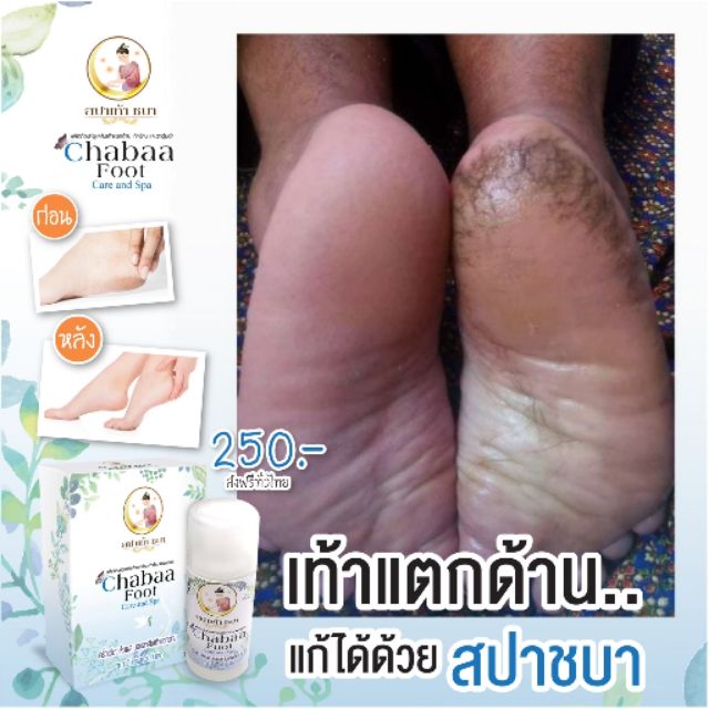 น้ำยาขัดส้นเท้าแตก​ เพียงแปะทิ้งไว้10นาที​ ขัดออกหมด แถมฟรี โฟมขัดเท้า ถุงมือ​ สำลี ❌️❌️ ครีมกล้วยหมดค่ะ❌️❌️