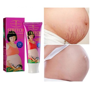 *ส่งจากไทยAichun Anti-Stretch  Mark Cream 120g. แก้แตกลาย ครีมบำรุงผิว ครีมซ่อมแซมผิว ครีมแก้ท้องลายลดผิวแตกลาย ลดผิวแตก