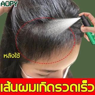 เหมาะกับทุกปัญหาผมร่วง AOPY สเปรย์ปลูกผม แก้ปัญหาหัวล้าน ป้องกันผมร่วง เร่งผมงอกใหม่ เร่งผมขึ้นใหม่ เซรั่มปลูกผม ปลูกผมข