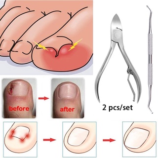 2 ชิ้น / เซต คีมแก้ไขเล็บเท้า กําจัดสิ่งสกปรกบนผิวหนังที่ตายแล้ว เครื่องมือความงามเล็บเท้า Paronychia