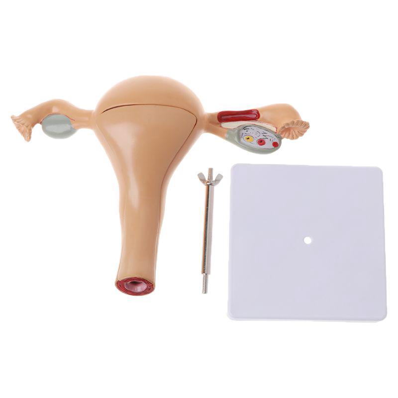 SEL♀ Human Pathological Uterus Ovary Model Anatomical Anatomy D