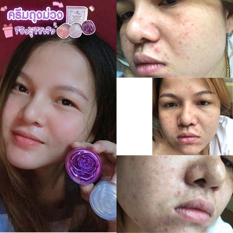 ครีมถุงม่วง ออร่าไบร์ท AuraBright ชุดเล็ก ลดสิว หน้าใส ขนาด 5กรัม - รูปที่ 3