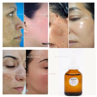 night cream to remove acne scars