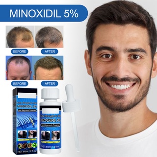 Minoxidil ทรีทเม้นท์บํารุงเส้นผม 5% แข็งแรงพิเศษ สําหรับผู้ชาย