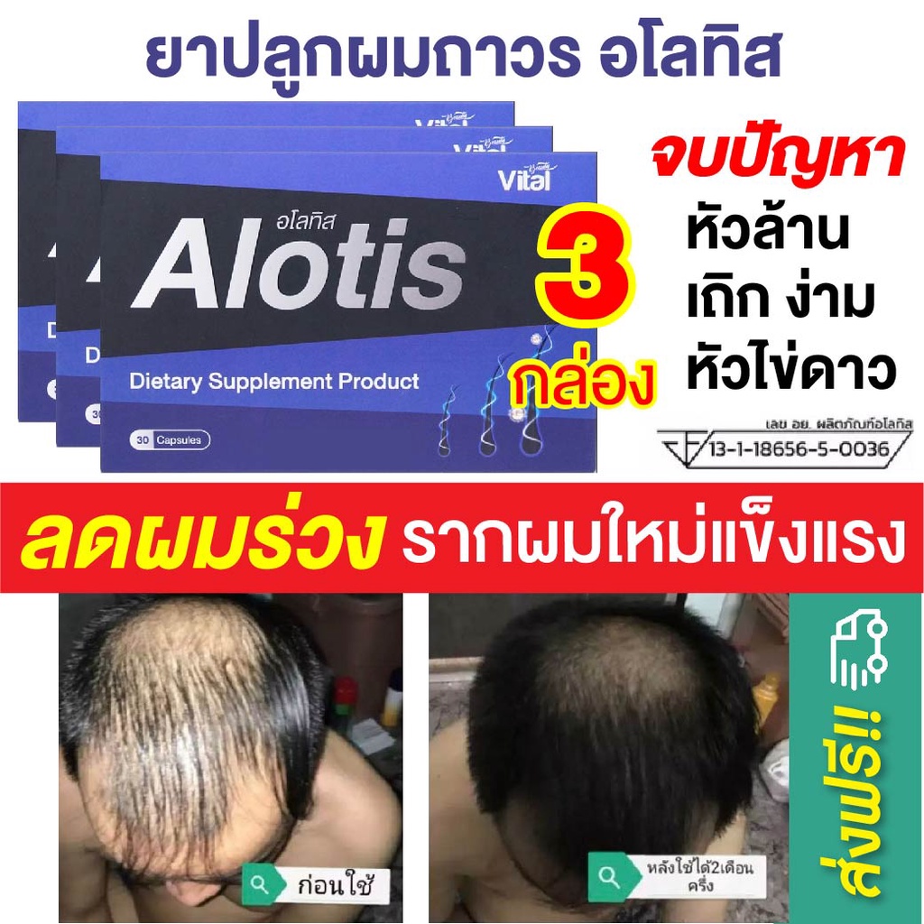 ยาปลูกผม Alotis อโลทิส 3 กล่อง ปลูกผม ลดผมร่วง ลดผมบาง หัวล้าน หัวเถิกไข่ดาว รากผมแข็งแรง เห็นผลจริง