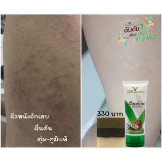 *ยางนา* แก้-ตุ่มคัน โรคผิวหนัง แพ้ง่าย (เซ็ต 2 ชิ้น มีโลชั่น 90 ml 1+ สบู่ละอองพรรณ ใหญ่ 1)