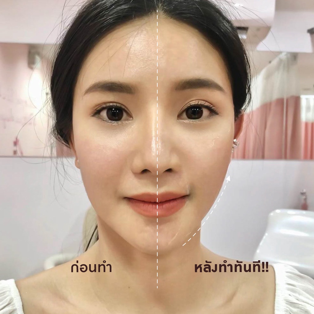 Premium Hifu By Doctor พรีเมียม ไฮฟู่ ทำโดยคุณหมอ