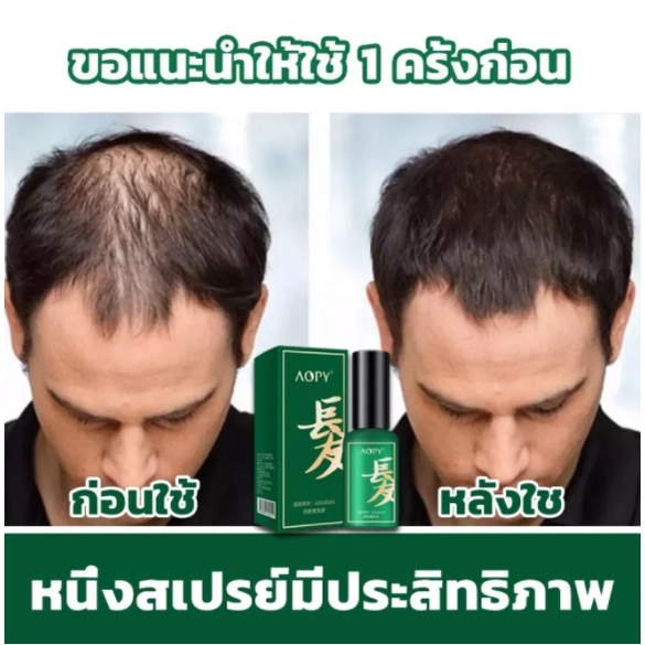 AOPY เซรั่มปลูกผม สเปรย์ปลูกผม บอกลาหัวล้าน ปลูกผม น้ำยาเร่งผมยาว ป้องกันผมร่วง เร่งผมงอกใหม่ HairGrowth