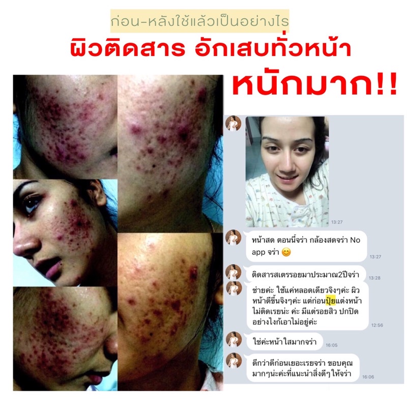KAPOR เจลว่านหางจระเข้ สูตรลดสิว ลดรอย ฟื้นฟูผิวติดสาร
