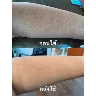 สเปรย์รักษาสิวที่หลัง สิวหน้าอก สิวใบหน้า สูตรแพทย์แผนไทย สเปรย์รักษารอยดำหลัง สเปรย์ใบชา