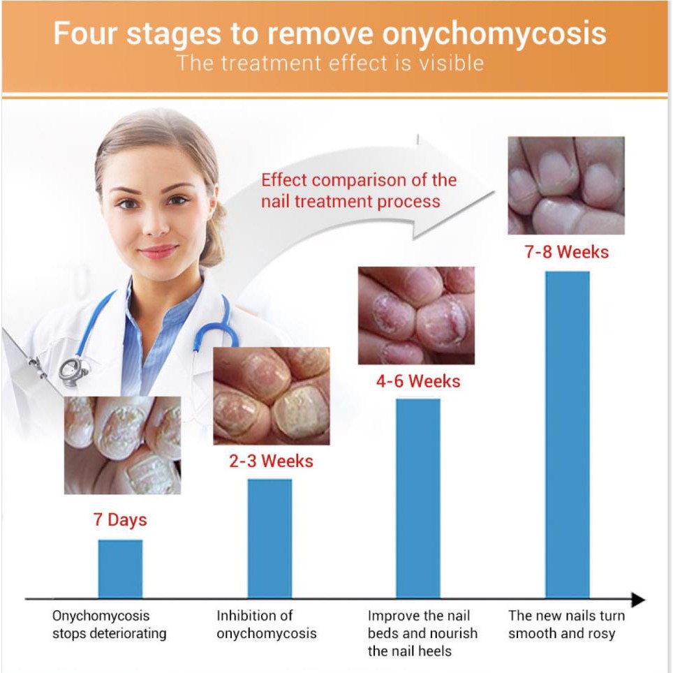 LANBENA เอสเซ้นส์ซ่อมแซมเล็บ Fungal Nail Treatment ลบ Onychomycosis Toe Nourishing Brighten Hand Foot Skin Care - รูปที่ 4