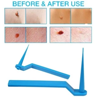 ✓✓จัดส่งในไทย✓✓ อุปกรณ์กำจัดหูด ไฝ ติ่งเนื้อ หลุดออกอย่างง่ายดาย Medical Skin Tag Kill Remover ไม่ต้องใช้ เครื่องจี้ไฝ