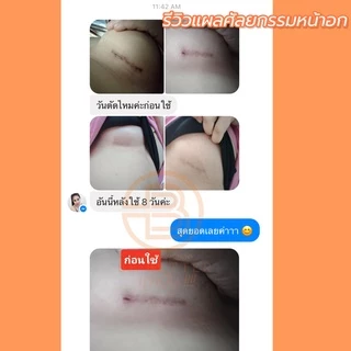 เจลสมานผิว ลดรอยแผลเป็น Be Better 1 ขวด ขนาด 15 ML. รักษารอยสิว รอยดำ แผลไฟไหม้ กะทะดาด รอยแผลเป็นต่างๆ